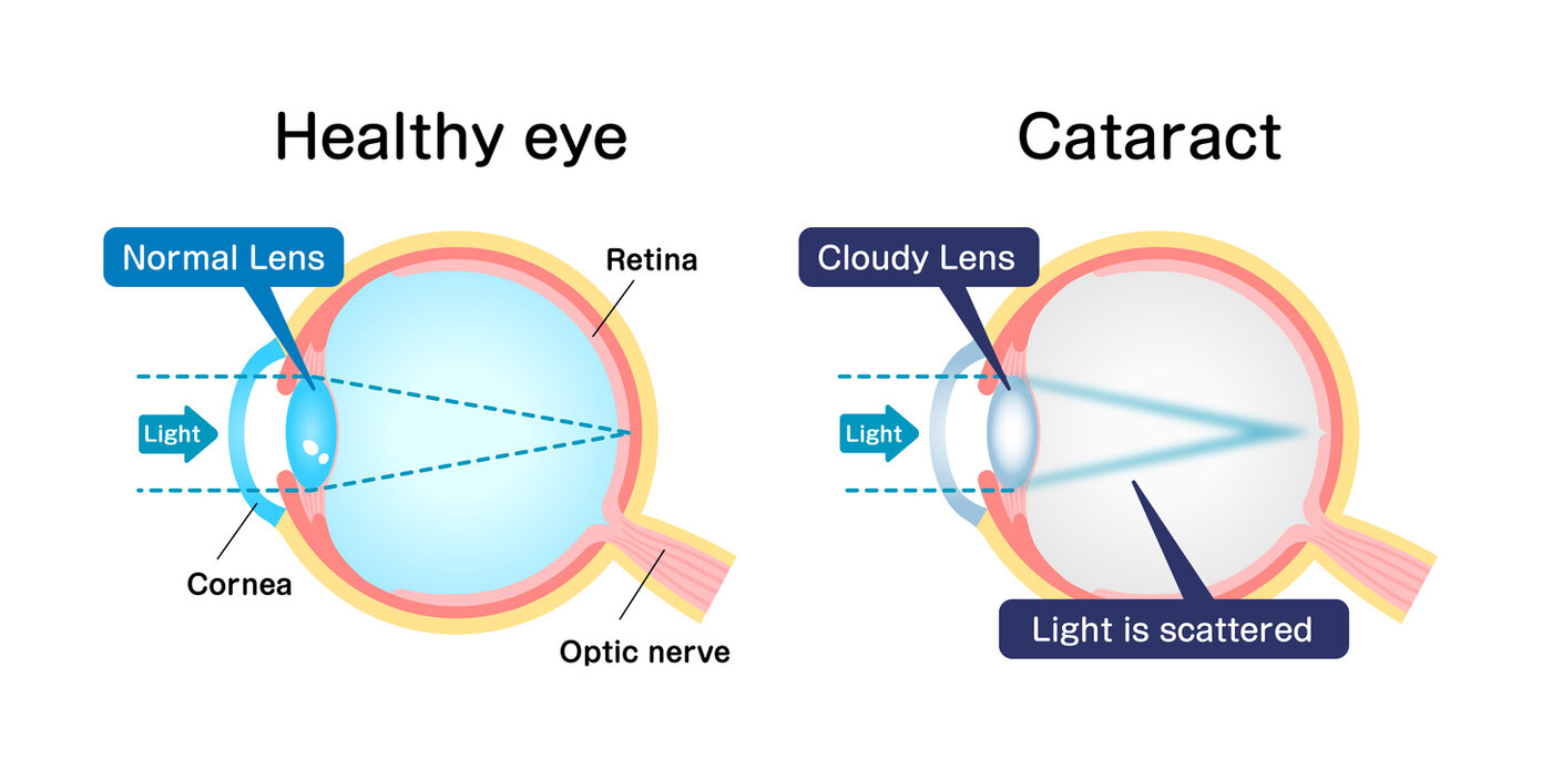 Side-by-side anatomical diagram comparing a healthy eye with a clear lens to an eye with a cataract showing a cloudy lens scattering light — explained during cataract co-management with Dr. Roxanna Gangi at Pro Eye Exam in York Region