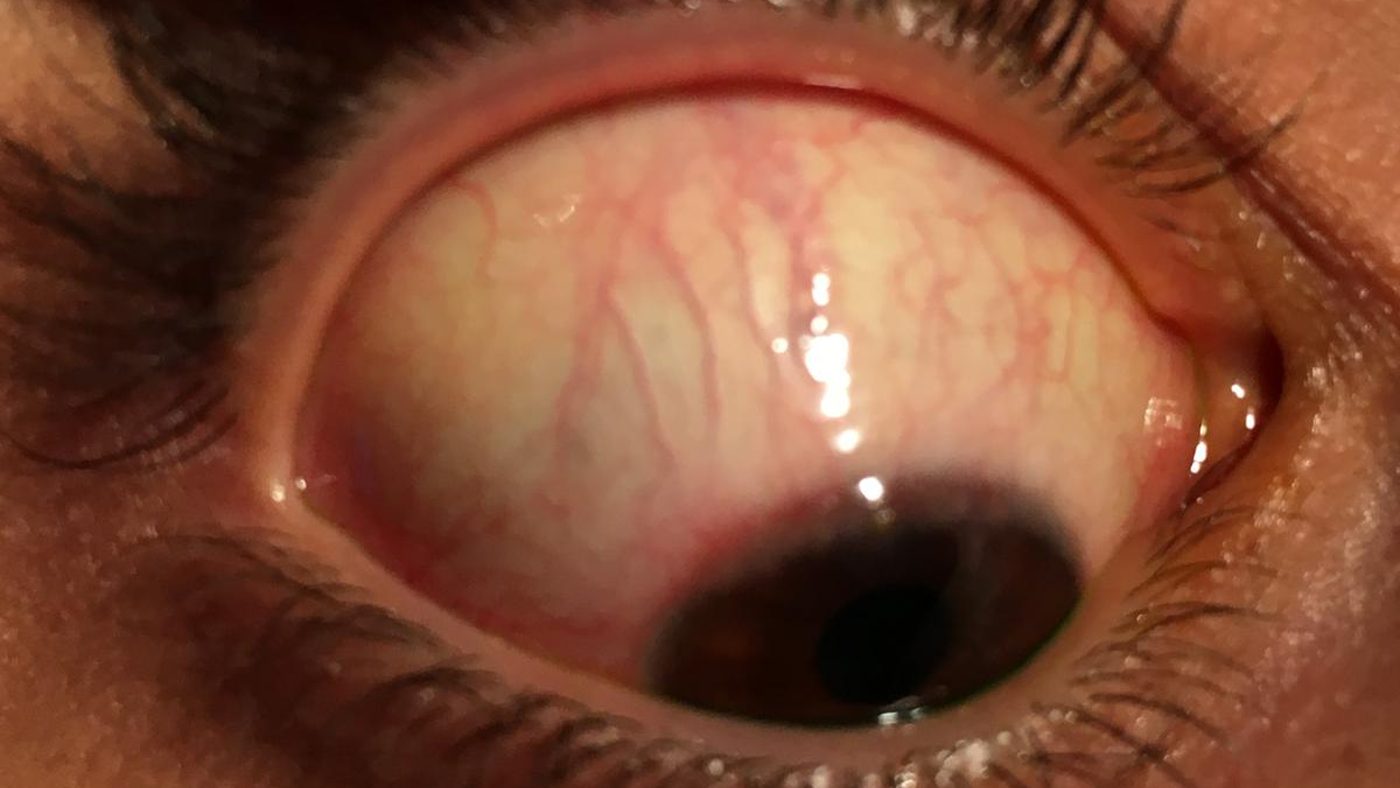 Close-up of a red, irritated eye showing a subconjunctival hemorrhage, dilated conjunctival blood vessels and ocular surface inflammation — examination and management of common eye conditions like red eye, allergies and infections with Dr. Roxanna Gangi, Optometrist at Pro Eye Exam in York Region