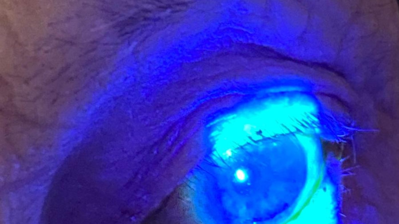 Slit-lamp examination of an eye stained with fluorescein dye under cobalt blue light, revealing dry eye damage and tear film breakup on the cornea — advanced dry eye assessment with Dr. Roxanna Gangi at Pro Eye Exam in York Region