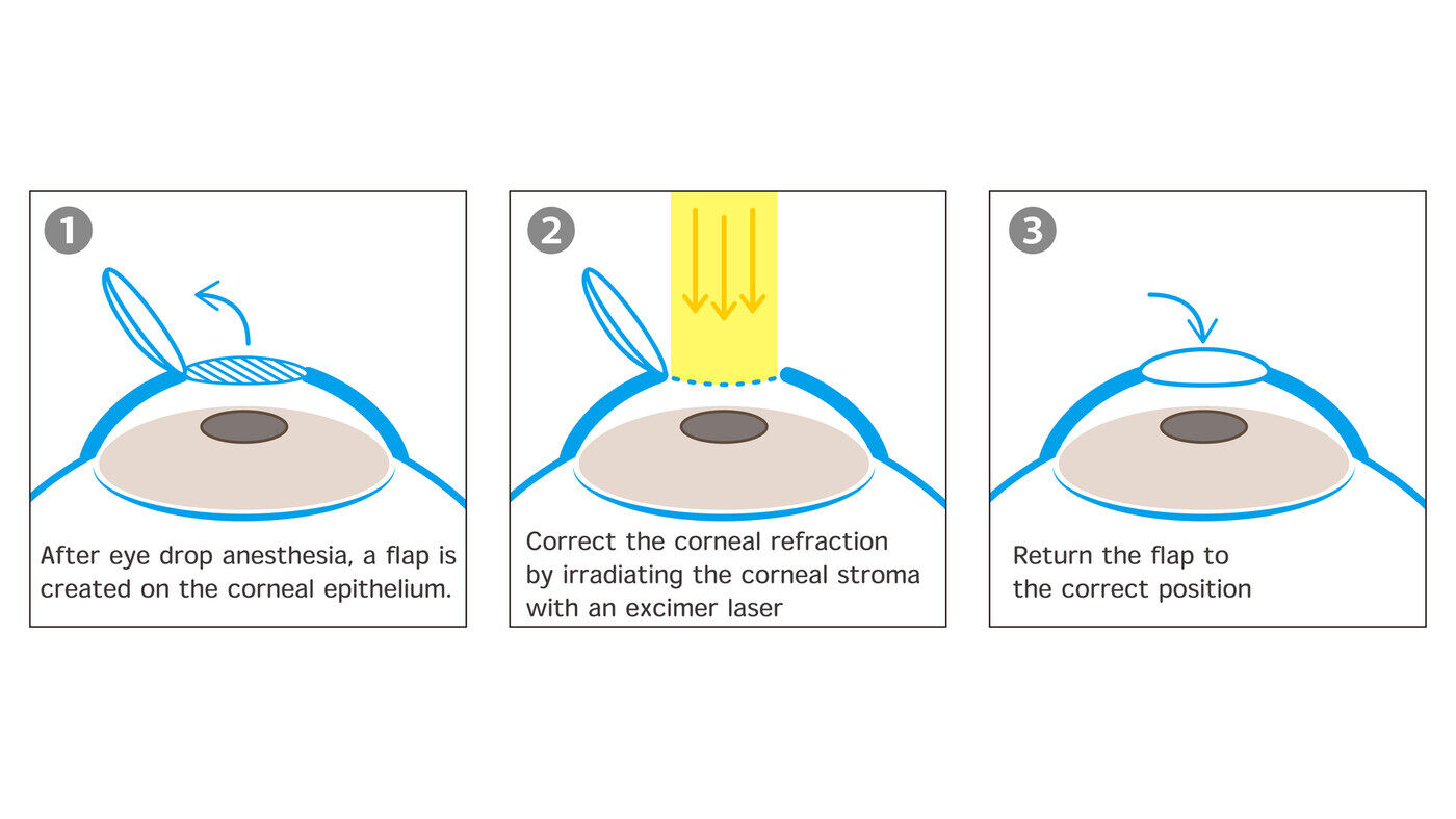 LASIK procedure steps diagram — corneal flap creation, excimer laser refractive correction, and flap repositioning explained during LASIK candidacy consultation with Dr. Roxanna Gangi at Pro Eye Exam in York Region