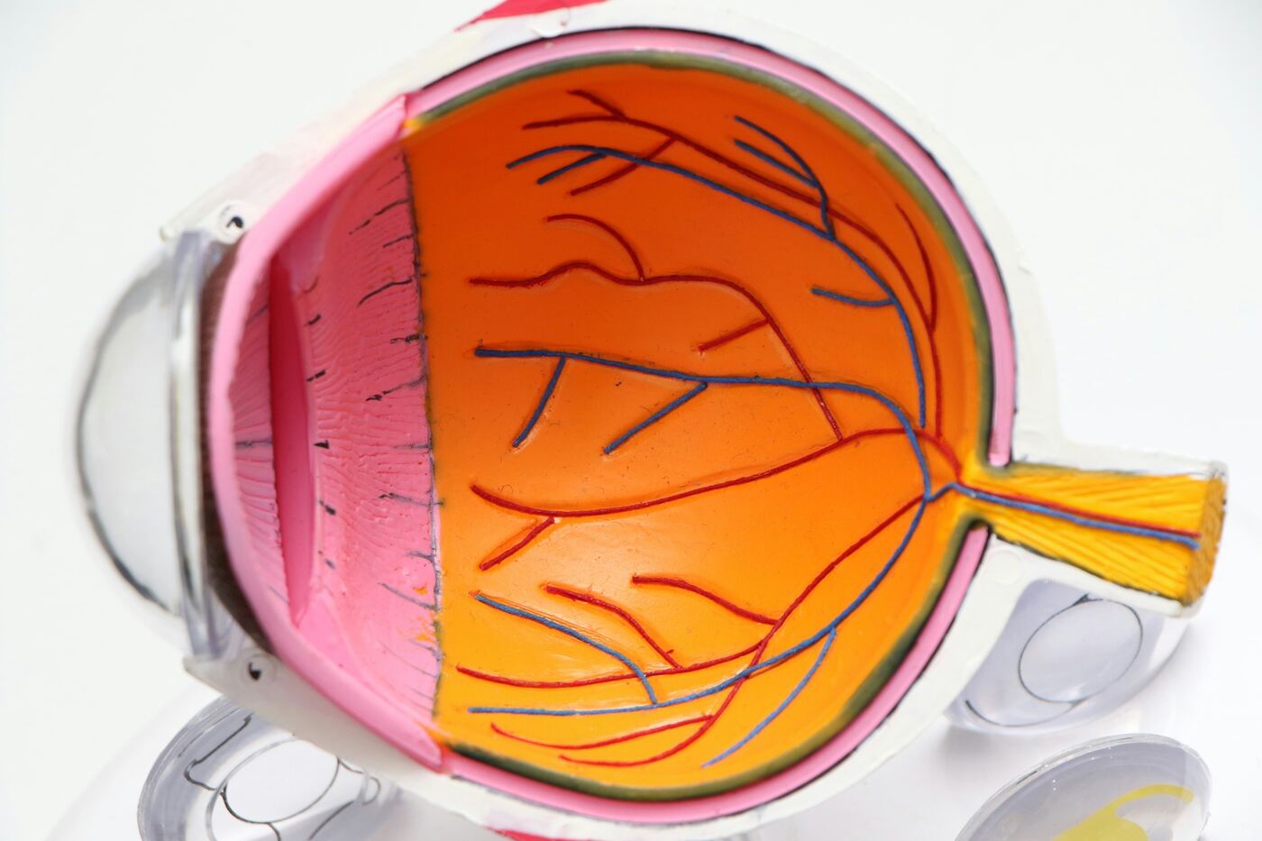 Eye anatomy model used during patient education by Dr. Roxanna Gangi